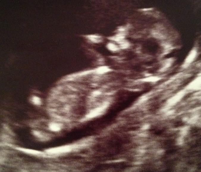 Ultrasound of a fetus